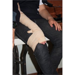 Using patient's leg for splint